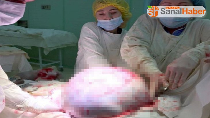 Rusya'da kadının yumurtalıklarından 25 kilogram tümör çıkarıldı