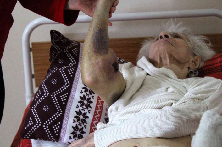 92 yaşında Covid-19´u yense de vücudunda oluşan yaralar tedirgin etti
