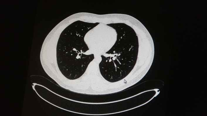 Aşılı ve aşısız olarak koronaya yakalanan 2 gencin akciğer tomografisi korkunç gerçeği gözler önüne serdi

